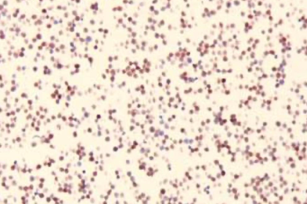 Cell block staining cells positive for T-cell Lymphoma