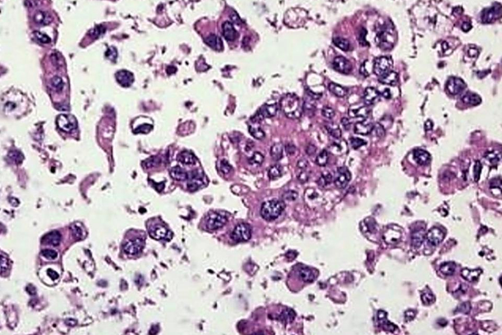 Non-Small Cell Carcinoma​