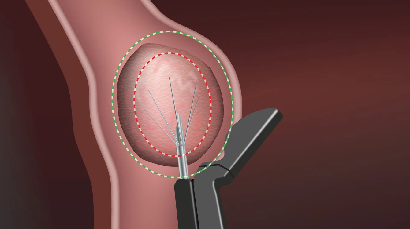 Visualisation of the Sonata device with needle electrodes deployed into a fibroid