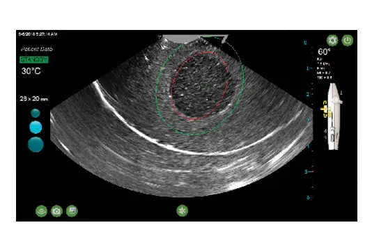 Ultrasound image with SMART Guide overlay