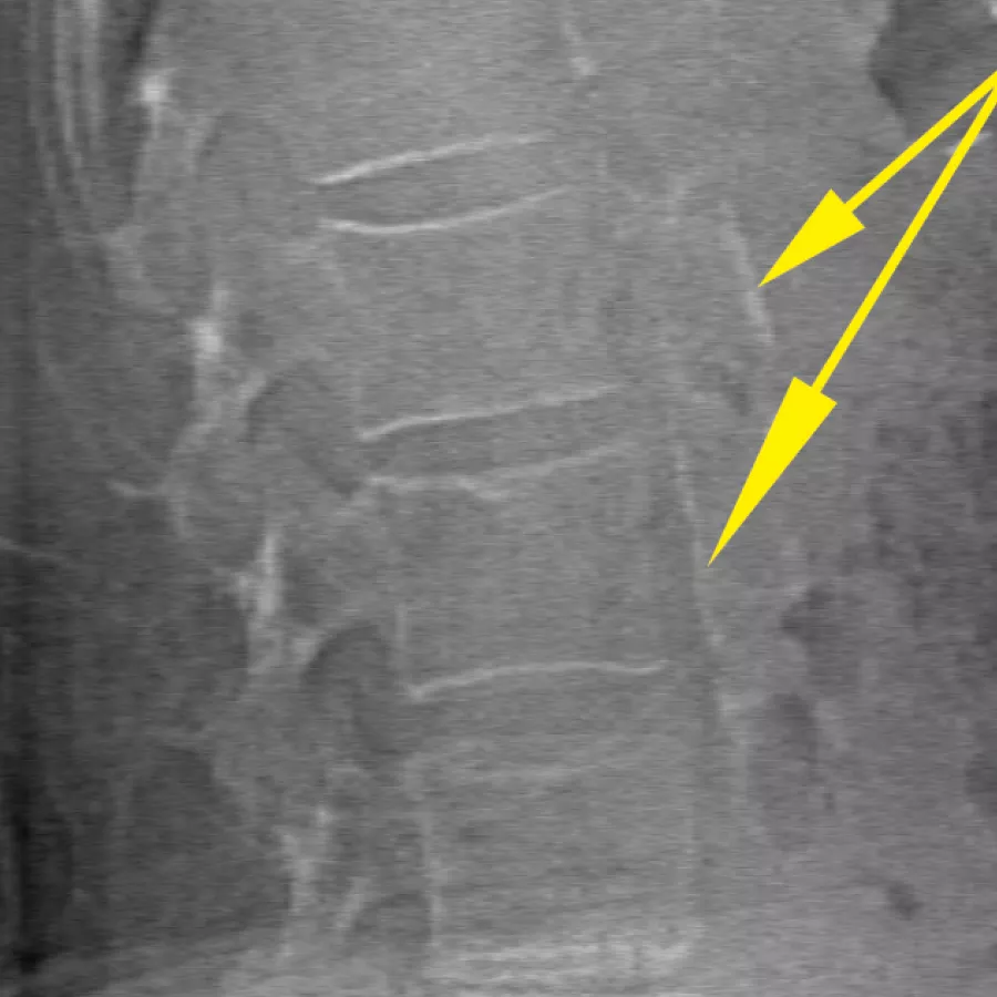BMD & Bone Imaging for Osteoporosis & Bone Disorders
