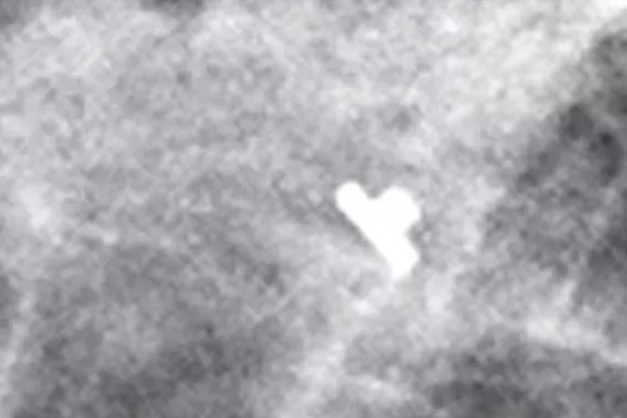 Top Hat Shape under mammography x-ray image