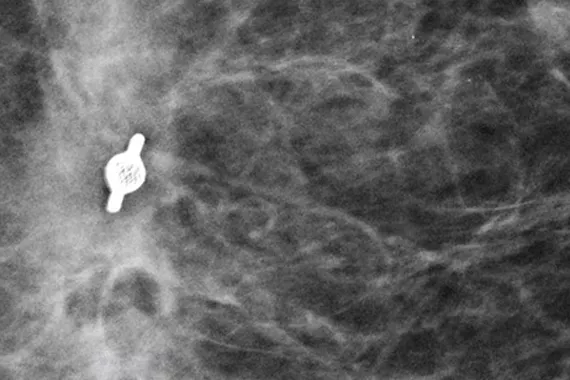 Biopsy site marker under mammography x-ray image