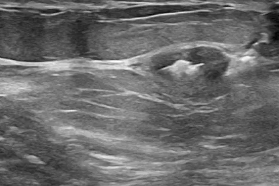 Ultrasound x-ray image