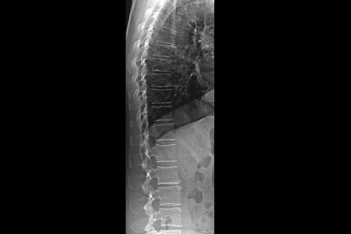 x-ray of spine