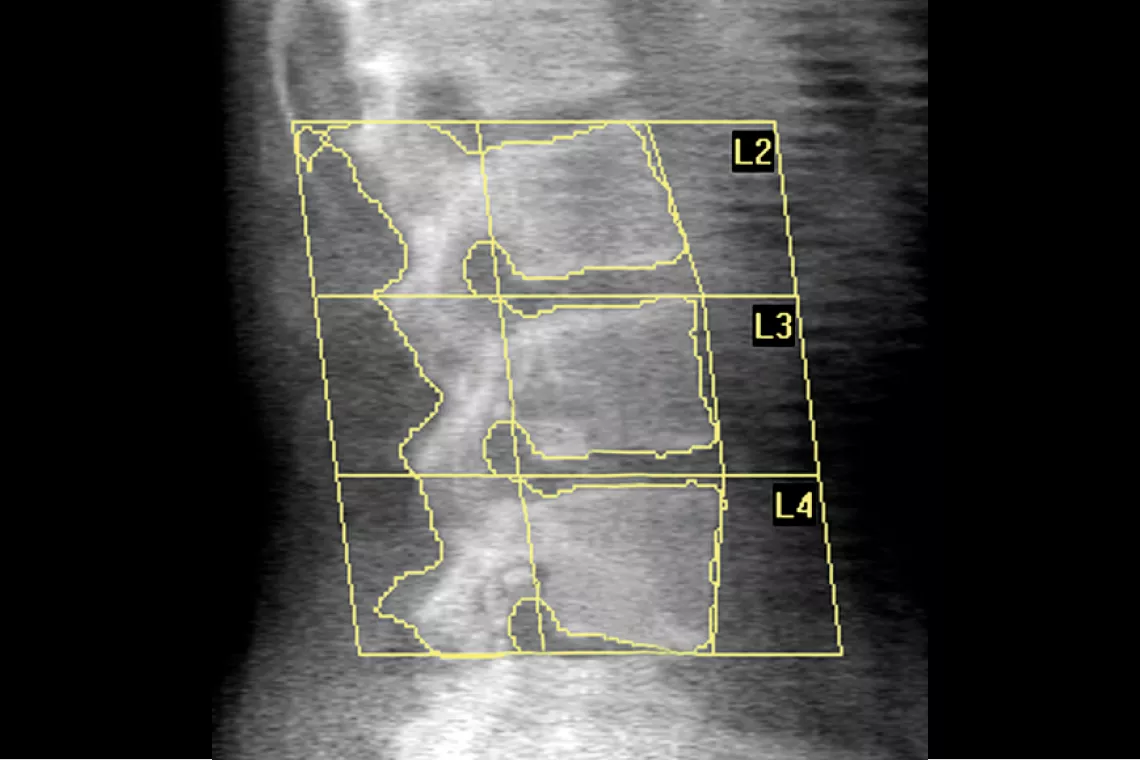 x-ray of spine
