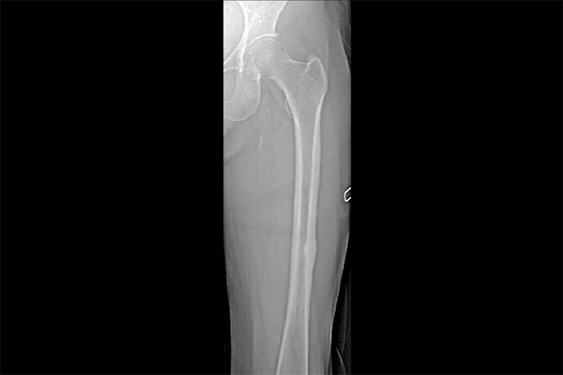x-ray of leg bone