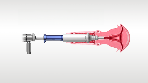 Illustration of medical device in use.