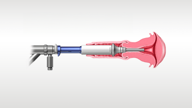 Illustration of medical device in use.