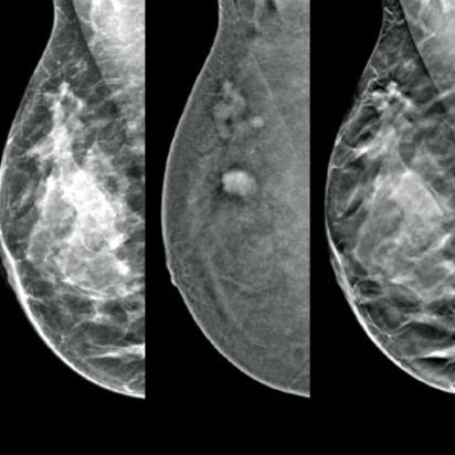 Hologic Hologic I-View® Contrast Enhanced Imaging